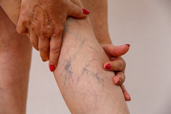 spider vein removal treatment Centennial CO MD Aesthetics and Body Contouring